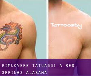 Rimuovere Tatuaggi a Red Springs (Alabama)