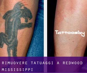 Rimuovere Tatuaggi a Redwood (Mississippi)