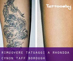 Rimuovere Tatuaggi a Rhondda Cynon Taff (Borough)
