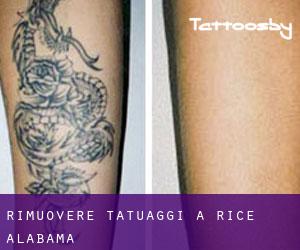 Rimuovere Tatuaggi a Rice (Alabama)