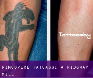 Rimuovere Tatuaggi a Ridgway Mill