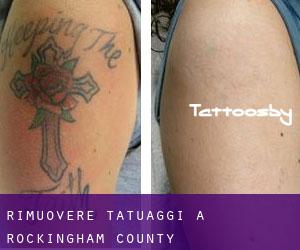 Rimuovere Tatuaggi a Rockingham County
