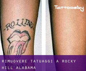 Rimuovere Tatuaggi a Rocky Hill (Alabama)