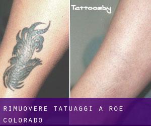 Rimuovere Tatuaggi a Roe (Colorado)