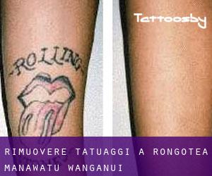 Rimuovere Tatuaggi a Rongotea (Manawatu-Wanganui)