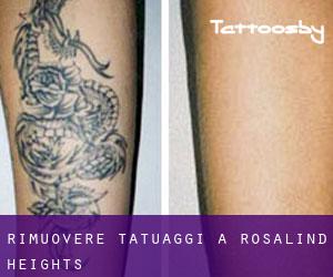 Rimuovere Tatuaggi a Rosalind Heights