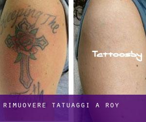 Rimuovere Tatuaggi a Roy