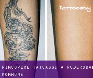 Rimuovere Tatuaggi a Rudersdal Kommune