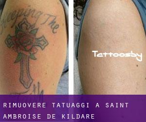 Rimuovere Tatuaggi a Saint-Ambroise-de-Kildare