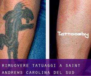 Rimuovere Tatuaggi a Saint Andrews (Carolina del Sud)
