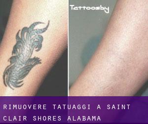 Rimuovere Tatuaggi a Saint Clair Shores (Alabama)