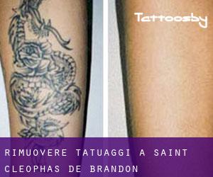 Rimuovere Tatuaggi a Saint-Cléophas-de-Brandon