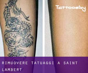 Rimuovere Tatuaggi a Saint-Lambert