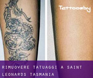 Rimuovere Tatuaggi a Saint Leonards (Tasmania)