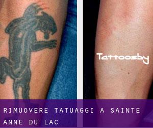 Rimuovere Tatuaggi a Sainte-Anne-du-Lac