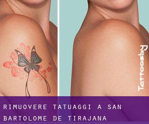 Rimuovere Tatuaggi a San Bartolomé de Tirajana