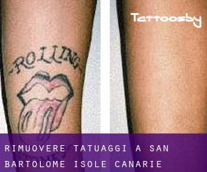 Rimuovere Tatuaggi a San Bartolomé (Isole Canarie)