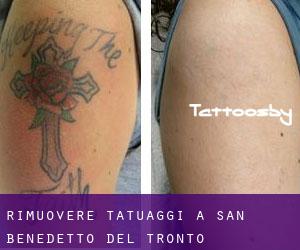 Rimuovere Tatuaggi a San Benedetto del Tronto