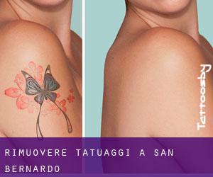 Rimuovere Tatuaggi a San Bernardo