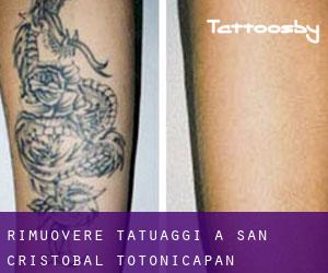 Rimuovere Tatuaggi a San Cristóbal Totonicapán