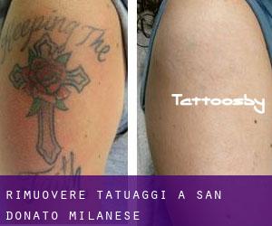 Rimuovere Tatuaggi a San Donato Milanese