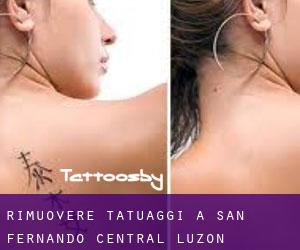 Rimuovere Tatuaggi a San Fernando (Central Luzon)