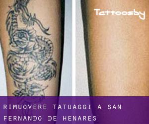 Rimuovere Tatuaggi a San Fernando de Henares