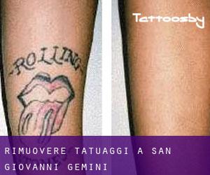 Rimuovere Tatuaggi a San Giovanni Gemini