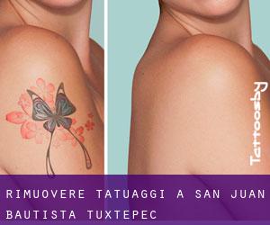 Rimuovere Tatuaggi a San Juan Bautista Tuxtepec