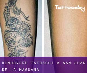 Rimuovere Tatuaggi a San Juan de la Maguana
