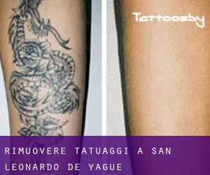 Rimuovere Tatuaggi a San Leonardo de Yagüe