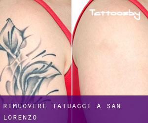 Rimuovere Tatuaggi a San Lorenzo