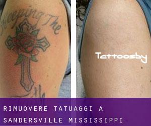 Rimuovere Tatuaggi a Sandersville (Mississippi)