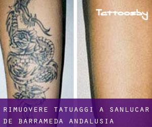Rimuovere Tatuaggi a Sanlúcar de Barrameda (Andalusia)