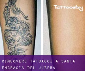 Rimuovere Tatuaggi a Santa Engracia del Jubera