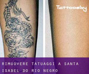 Rimuovere Tatuaggi a Santa Isabel do Rio Negro