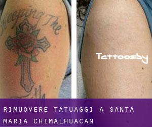Rimuovere Tatuaggi a Santa María Chimalhuacán