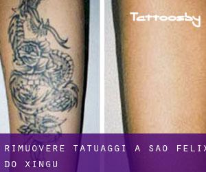 Rimuovere Tatuaggi a São Félix do Xingu