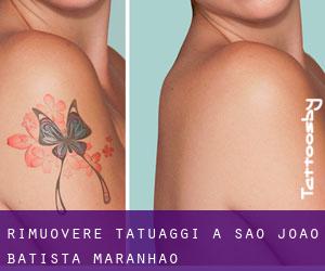 Rimuovere Tatuaggi a São João Batista (Maranhão)