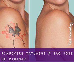 Rimuovere Tatuaggi a São José de Ribamar