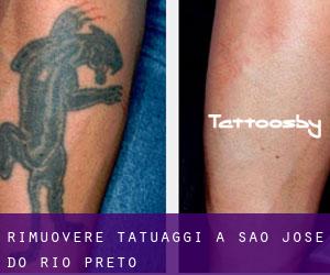 Rimuovere Tatuaggi a São José do Rio Preto