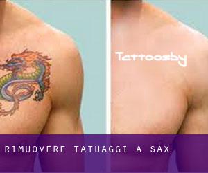 Rimuovere Tatuaggi a Sax
