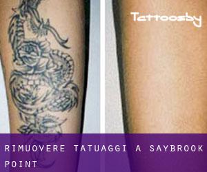 Rimuovere Tatuaggi a Saybrook Point