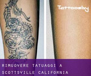 Rimuovere Tatuaggi a Scottsville (California)