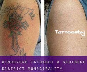 Rimuovere Tatuaggi a Sedibeng District Municipality