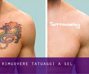 Rimuovere Tatuaggi a Sel