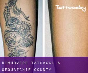 Rimuovere Tatuaggi a Sequatchie County