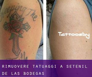 Rimuovere Tatuaggi a Setenil de las Bodegas