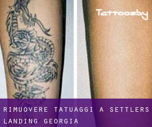 Rimuovere Tatuaggi a Settlers Landing (Georgia)