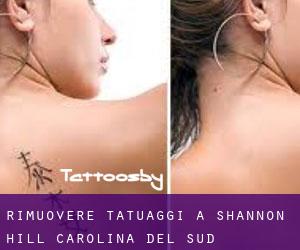 Rimuovere Tatuaggi a Shannon Hill (Carolina del Sud)